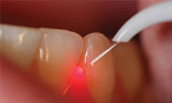 Close-up picture of a dental  laser treatment being done at at Premier Holistic Dental in beautiful Costa Rica.  The picture shows a red laser light being directed at an infected gum.